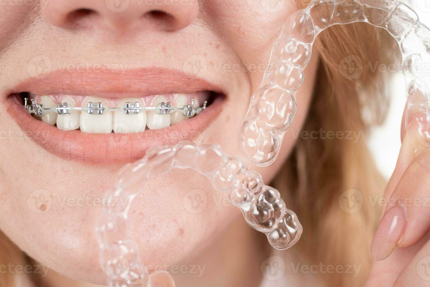 dentaire soins.souriant fille avec un appareil dentaire sur sa les dents détient aligneurs dans sa mains et spectacles le différence entre leur photo