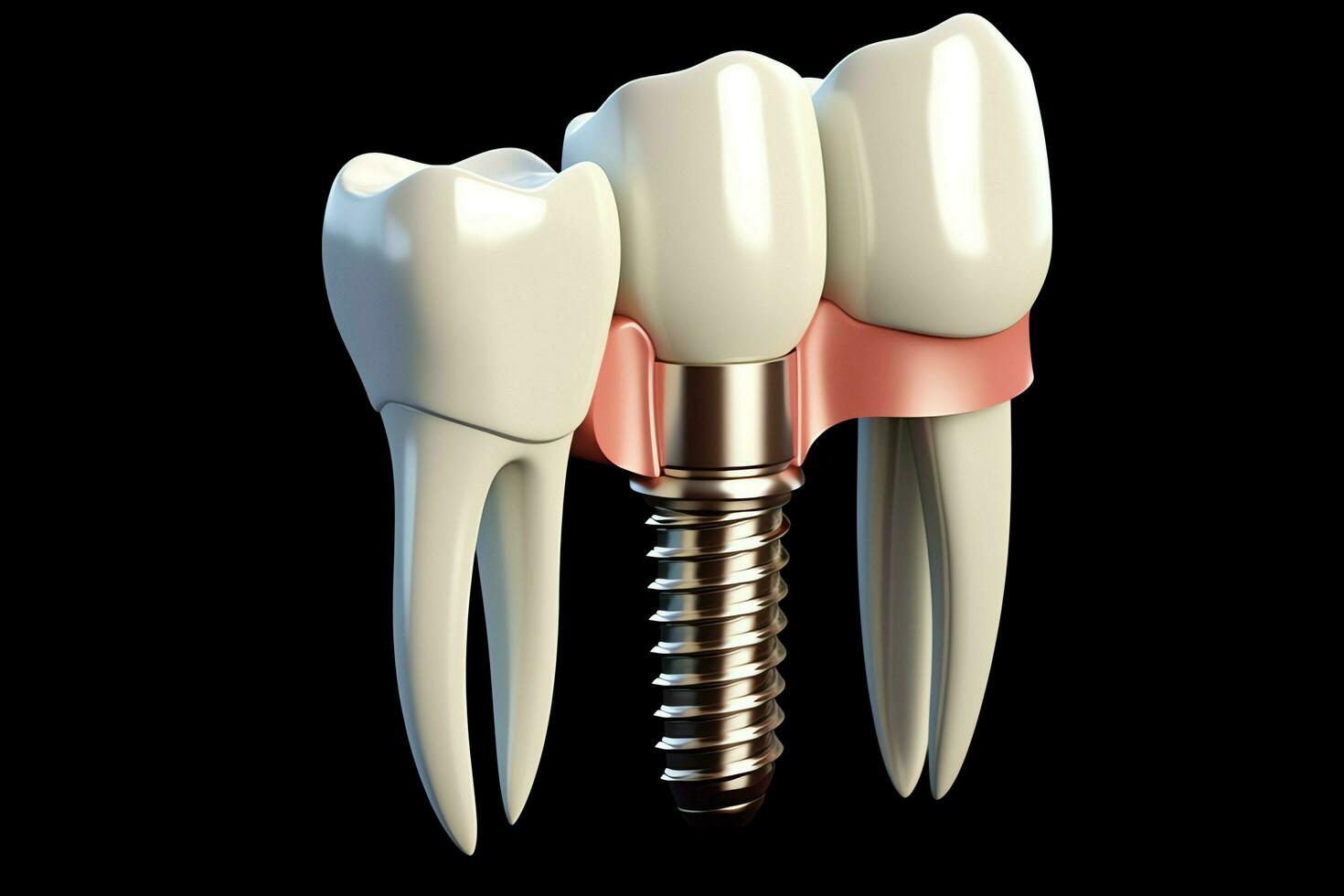 proche en haut de une dentaire dent implant ou en bonne santé Humain dents. blanc émail et dentaire implants chirurgie concept par ai généré photo