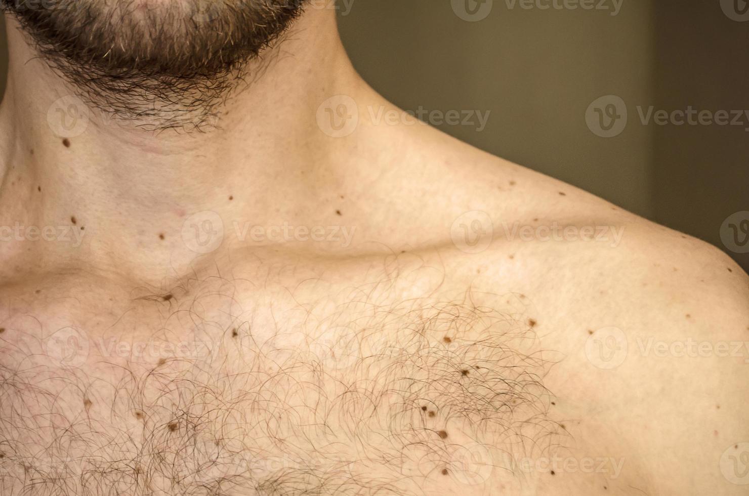 la clavicule d'un jeune homme. taupes photo