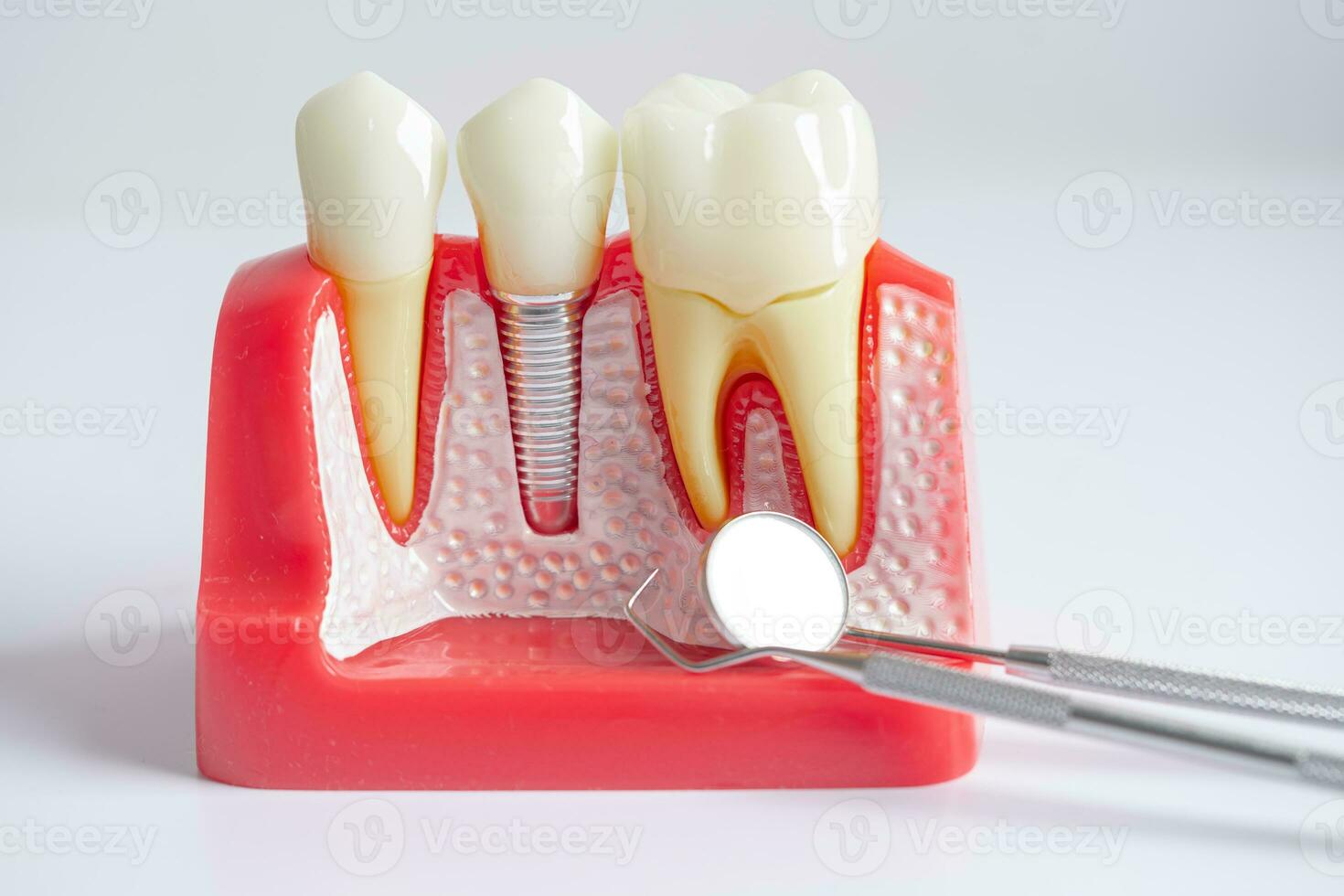 dentaire implant, artificiel dent les racines dans mâchoire, racine canal de dentaire traitement, gencive maladie, les dents modèle pour dentiste en train d'étudier à propos dentisterie. photo