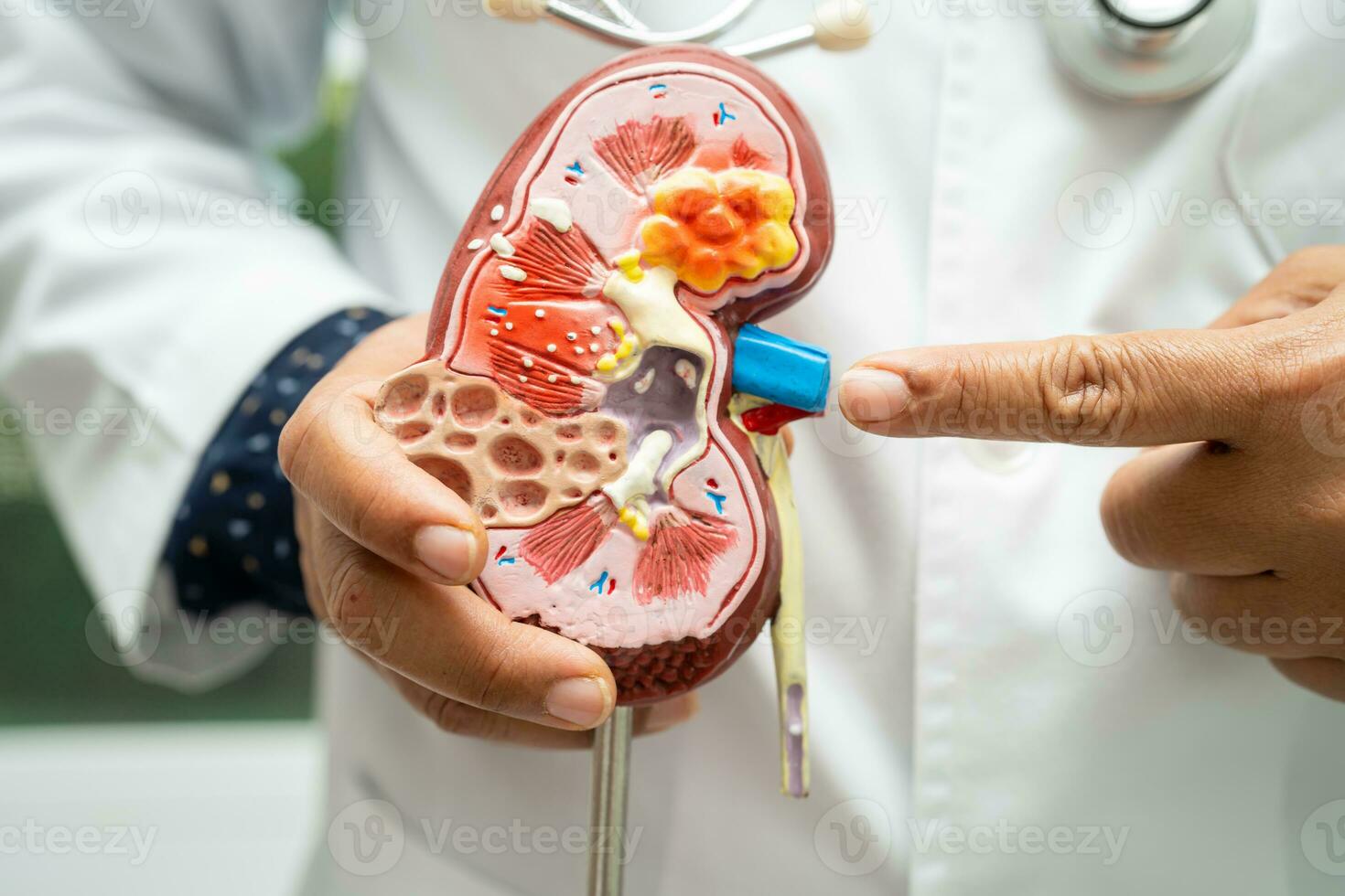 un rein maladie, chronique un rein maladie ccd, médecin tenir modèle à étude et traiter dans hôpital. photo