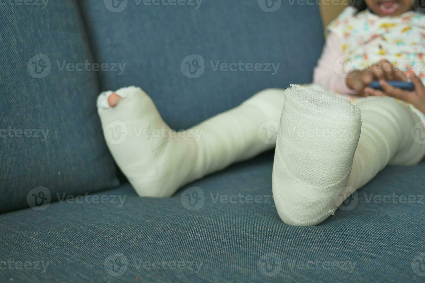 peu enfant avec plâtre bandage sur jambe. photo