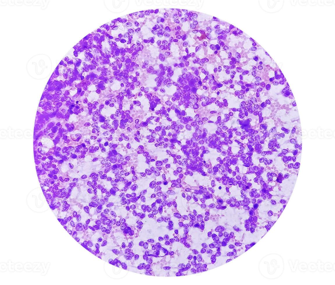 usg guidé fna cytologie de foie sol montrant non Hodgkins lymphome. métastatique carcinome photo