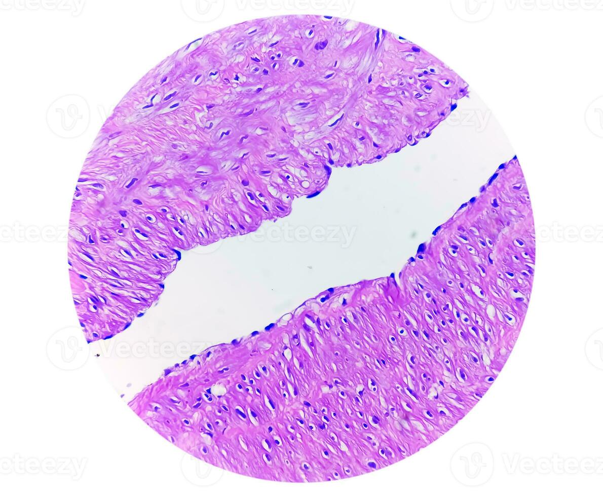 photomicrographie, prépatellaire Région histologie montrant bursite, aigu ou chronique bursite. photo