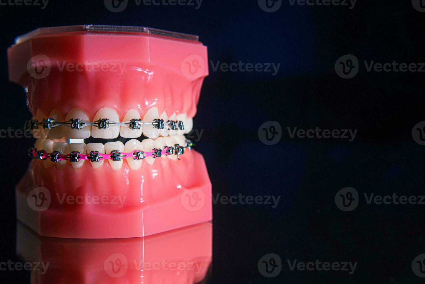 le un appareil dentaire sont sur le les dents dans le artificiel mâchoire sur une noir Contexte. fermer photo