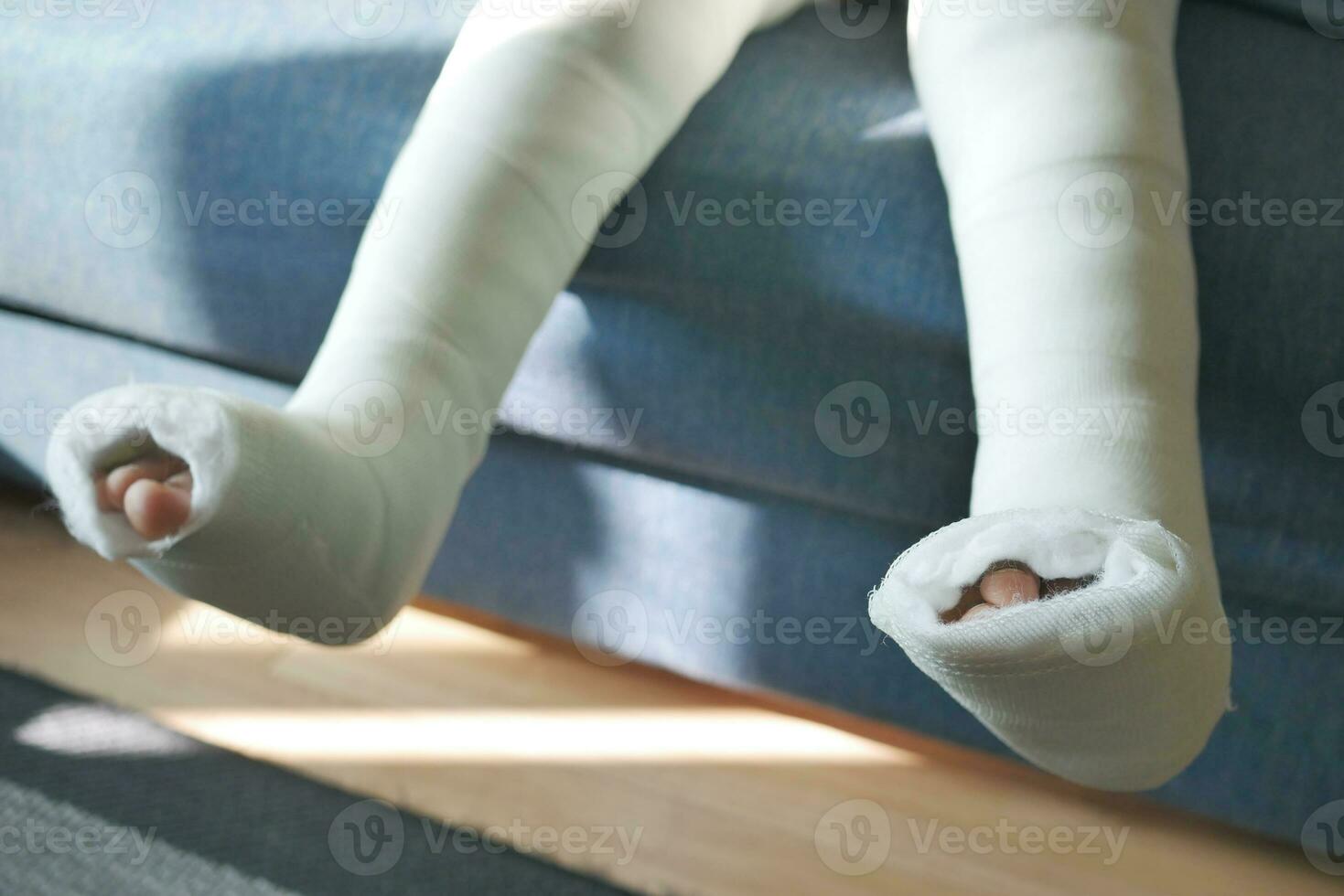 peu enfant avec plâtre bandage sur jambe. photo