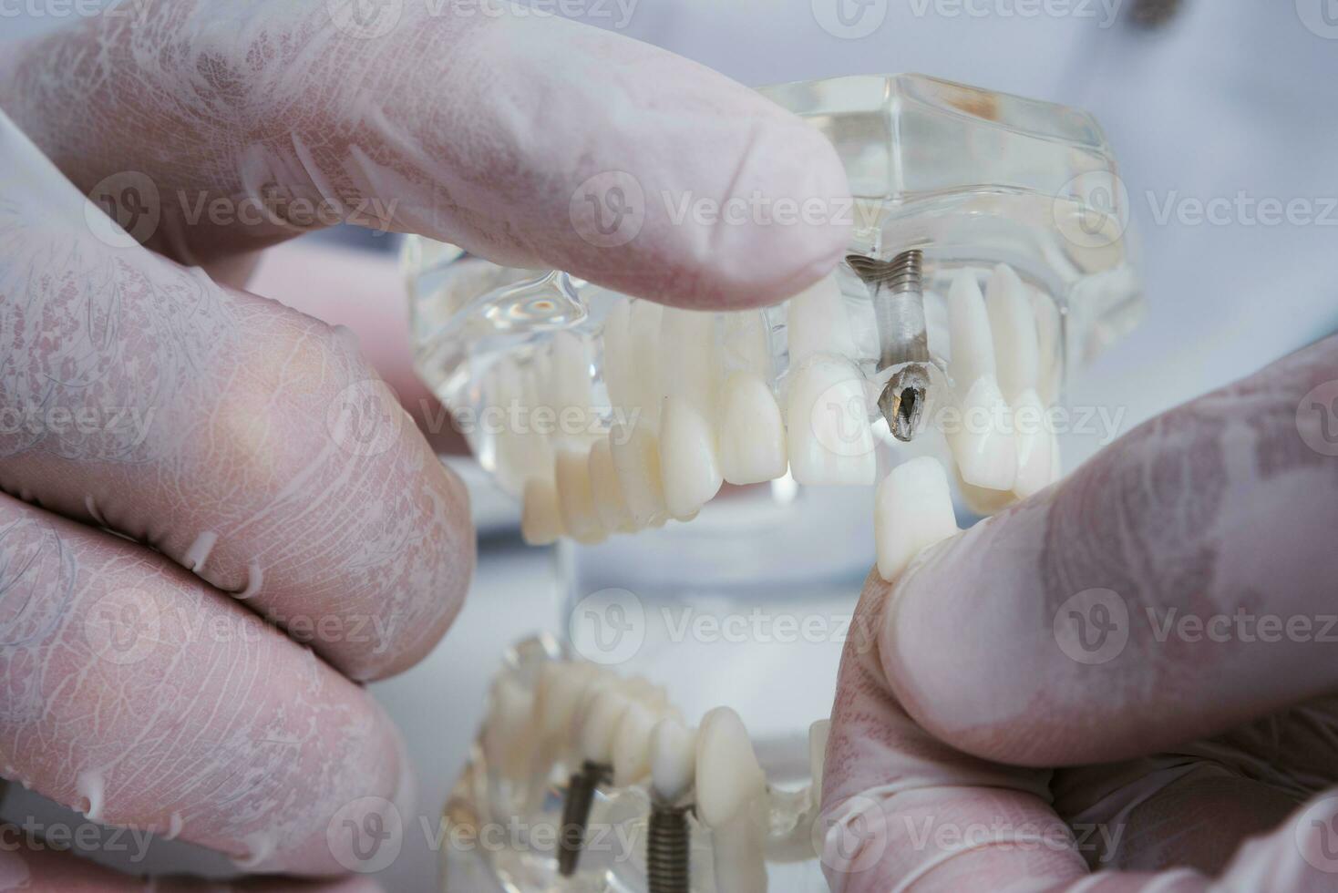 le orthodontiste détient une modèle de les dents avec implants dans le sien main et spectacles Comment à insérer le dent. proche en haut. macro photo