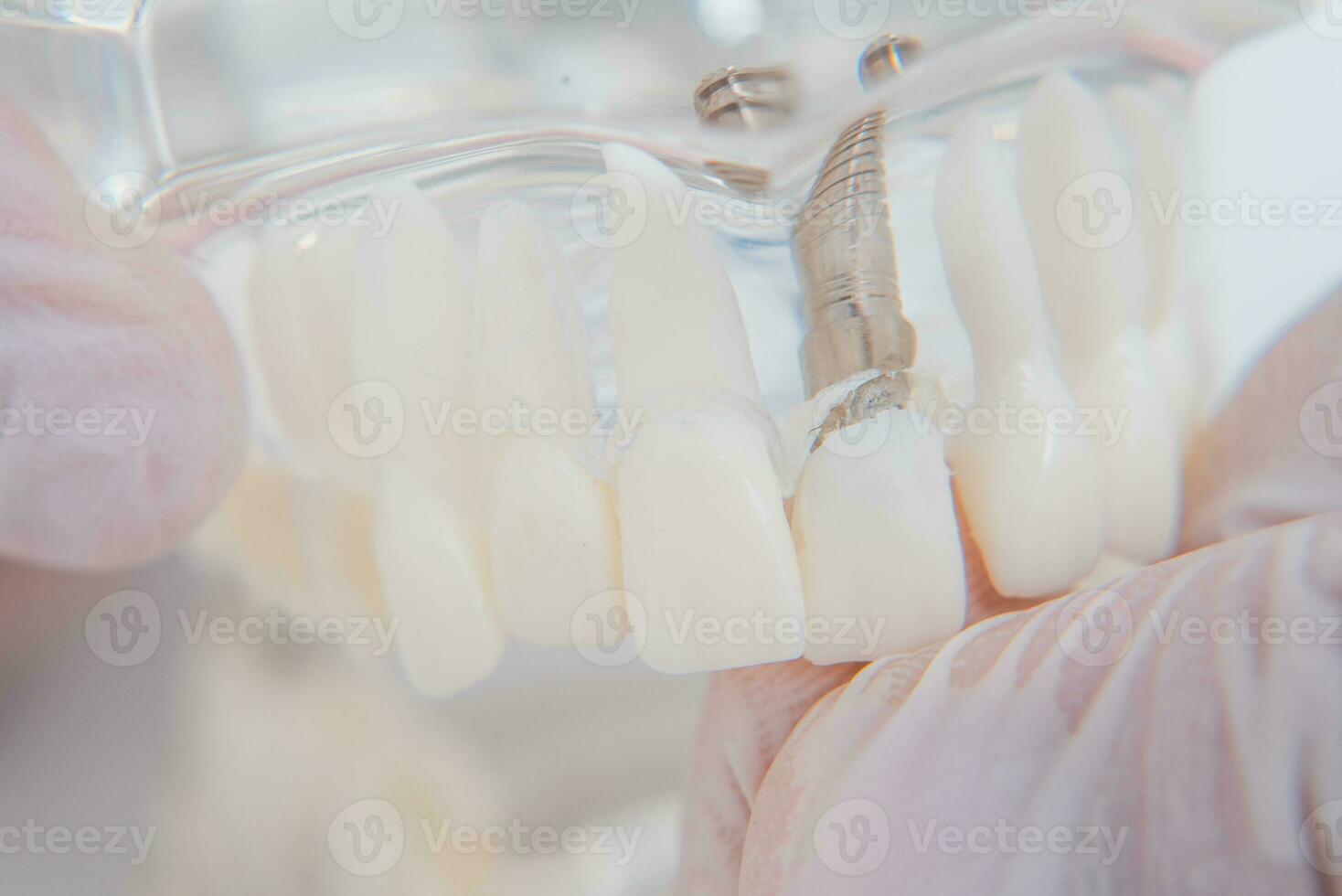 le orthodontiste détient une modèle de les dents avec implants dans le sien main et spectacles Comment à insérer le dent. proche en haut. macro photo