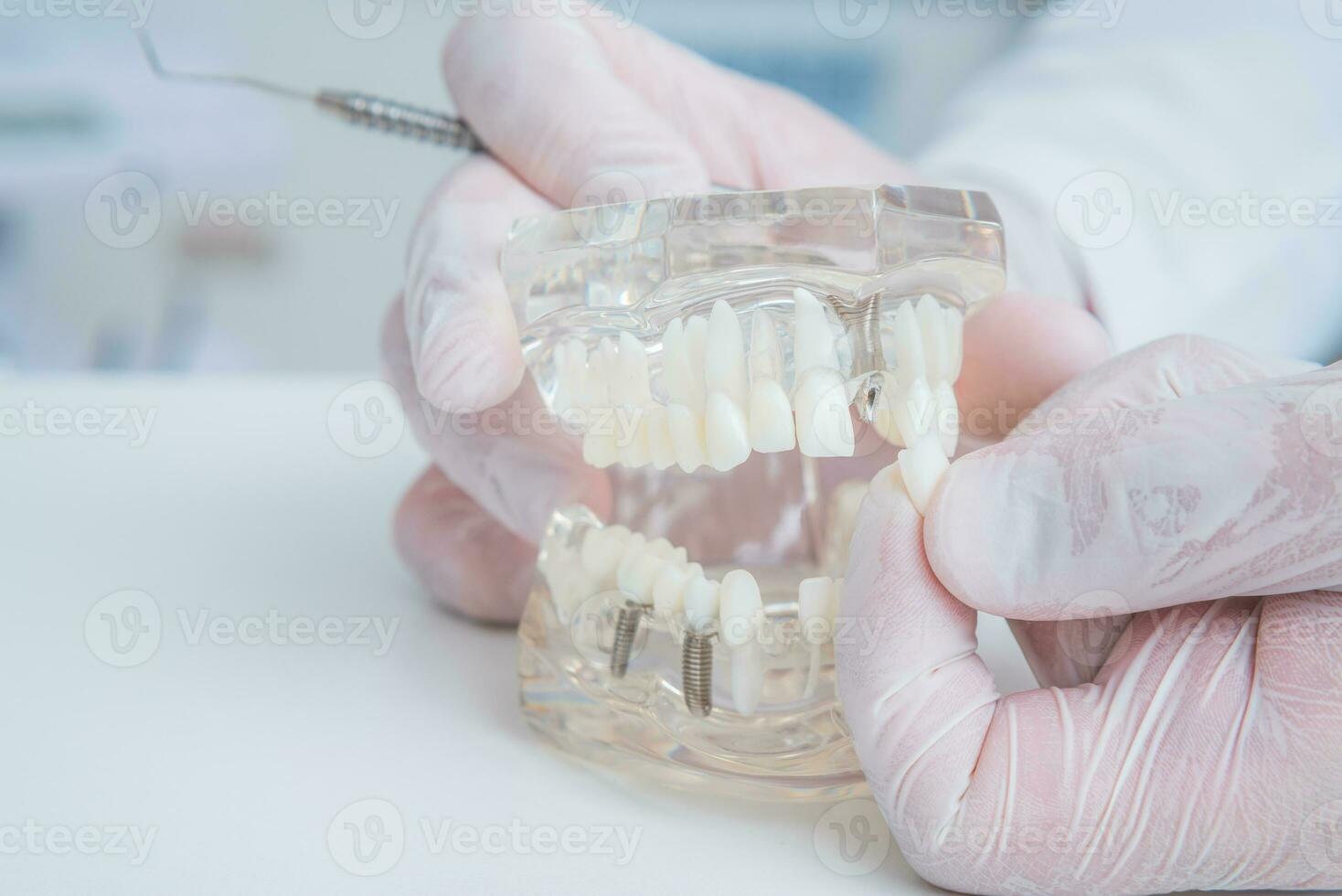 le orthodontiste détient une modèle de les dents avec implants dans le sien main et spectacles Comment à insérer le dent. proche en haut. macro photo