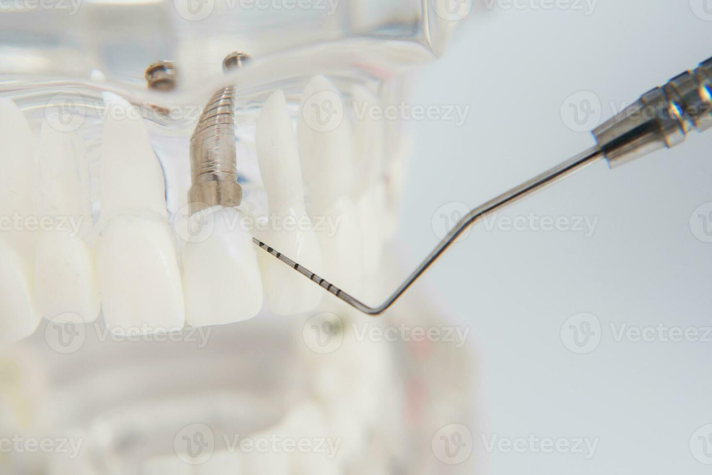 une modèle de les dents avec implants mensonges sur une table photo