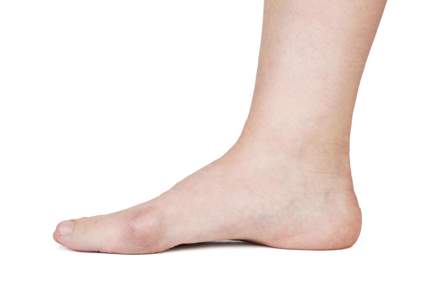 pied humain avec hallux valgus photo