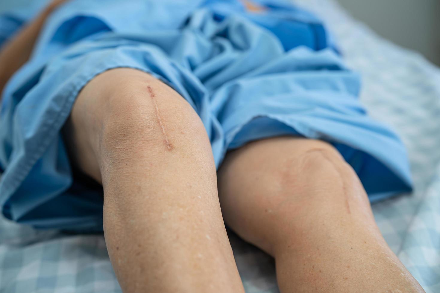 Une patiente asiatique âgée ou âgée montre ses cicatrices Remplacement chirurgical total de l'articulation du genou Chirurgie des plaies arthroplastie sur lit dans une salle d'hôpital de soins infirmiers, concept médical fort et sain photo