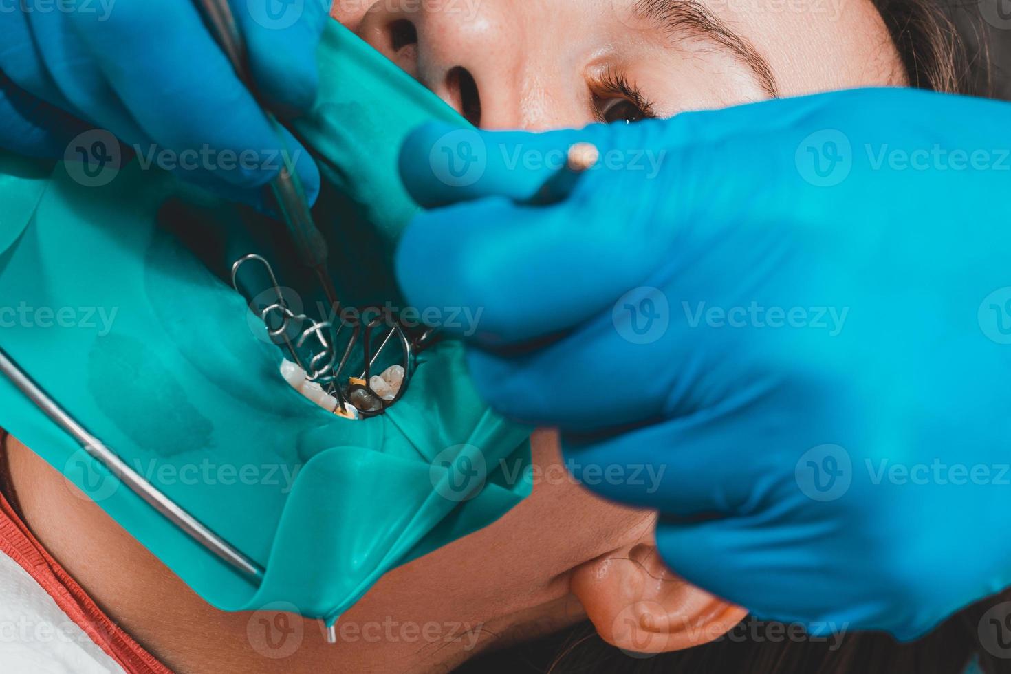 restauration d'une surface de mastication au moyen d'un matériau photo