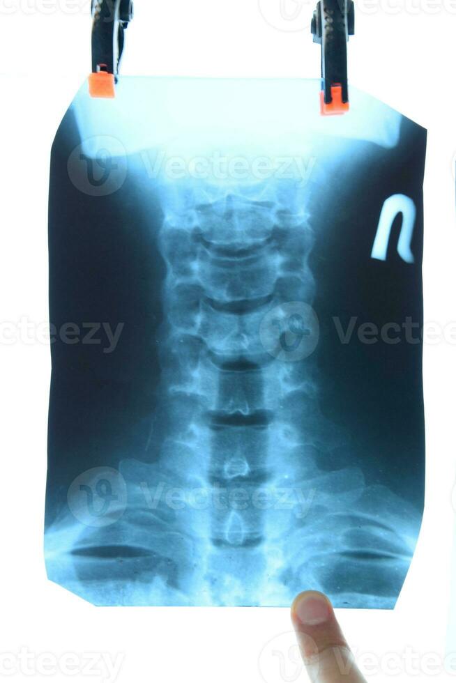 radiographie de le cervical vertèbres. X rayon image de le cervical colonne vertébrale. photo