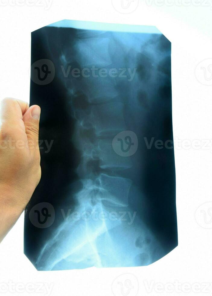 X rayon de le lombaire colonne vertébrale, colonne vertébrale sur radiographie photo