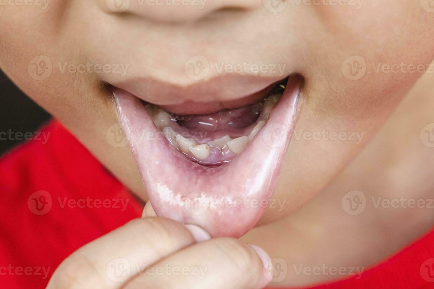 enfant Lait les dents tomber en dehors de gencive. peu garçon permanent dent grandit dans bouche. mignonne enfant ouvert sa bouche spectacle les dents et gommes. concept de santé, dentiste, hygiène, médical, en bonne santé dents, dentaire clinique. photo