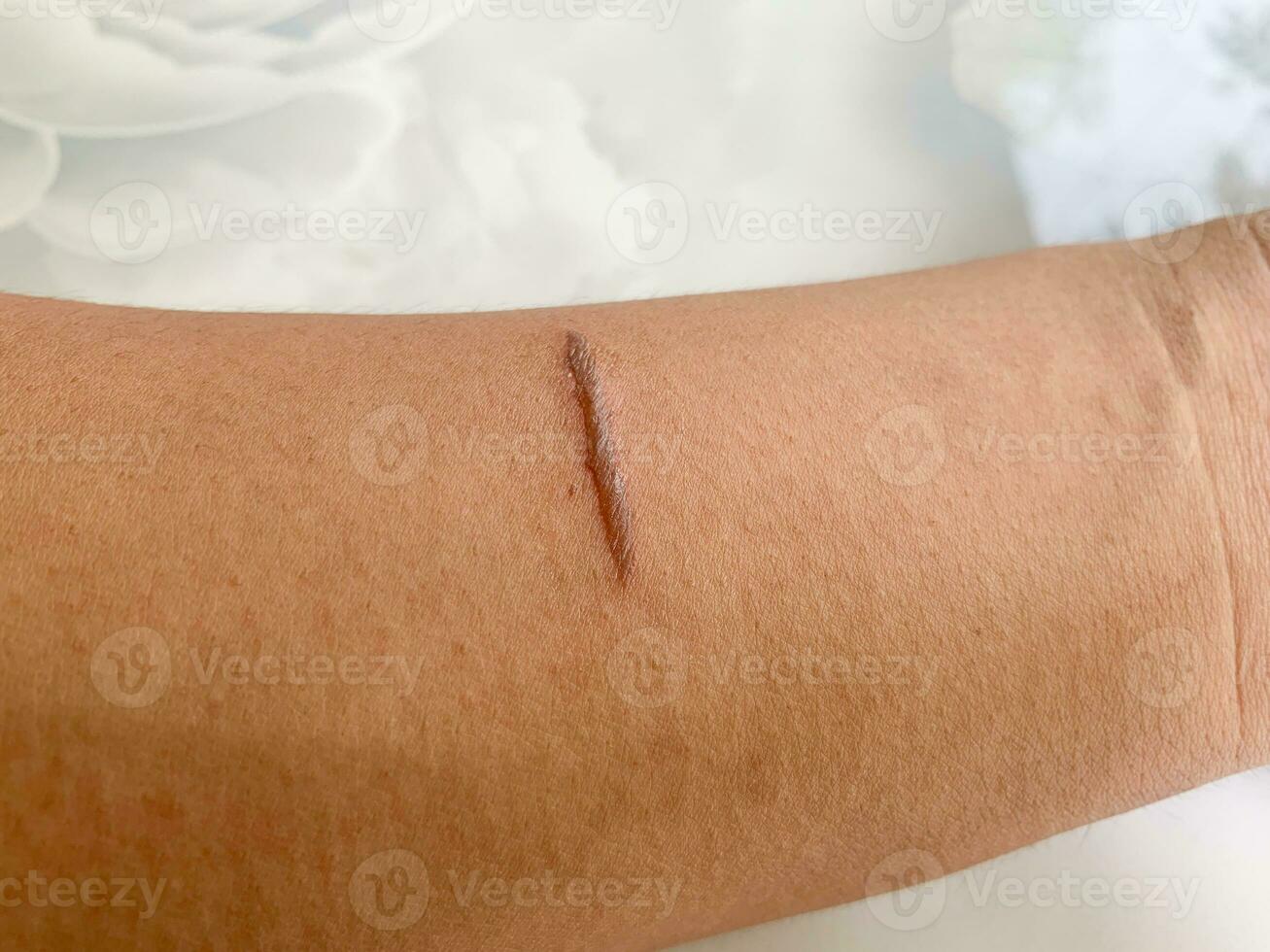 Haut vue de des brûlures blessure sur main peau faire droit ligne forme photo