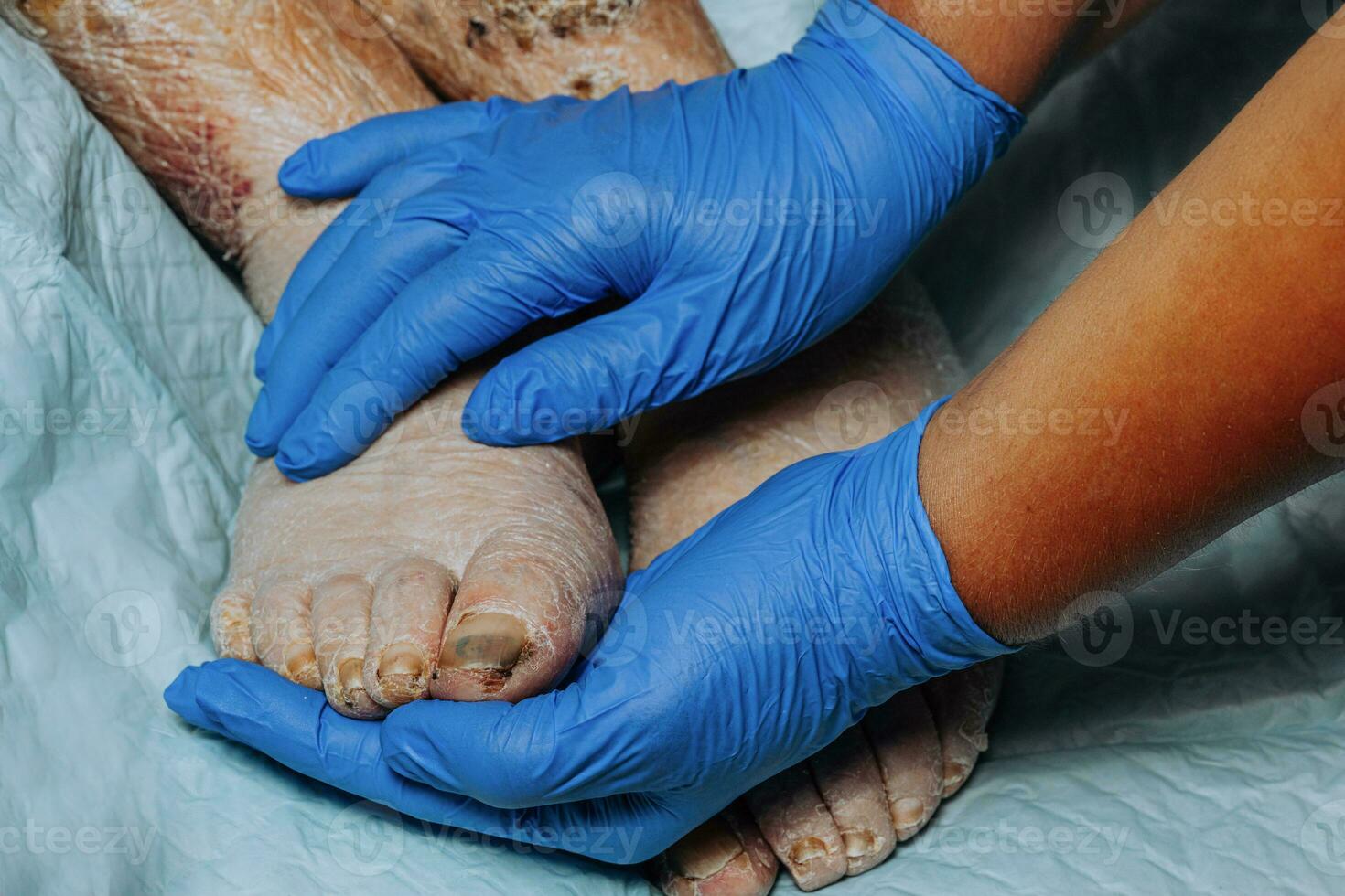 sur le jambes de un personnes âgées femme, le peau pelures de dû à eczéma, gonflement de le jambes. jaunissement de le clou plaque. gonflement de le jambes. conséquences de Diabète dans le âgé. personnes âgées se soucier photo