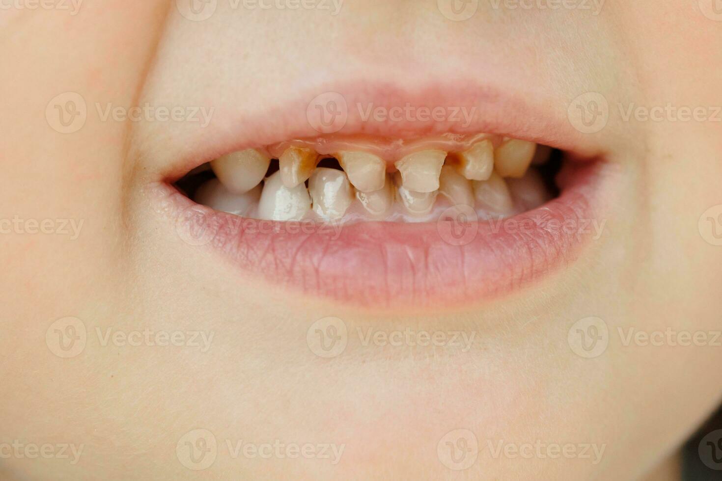 enfants Lait les dents avec carie. fermer de mauvais pour la santé Lait dents. dentaire médicament et soins de santé - les patients ouvert bouche montrant carie. enfants dentiste. photo