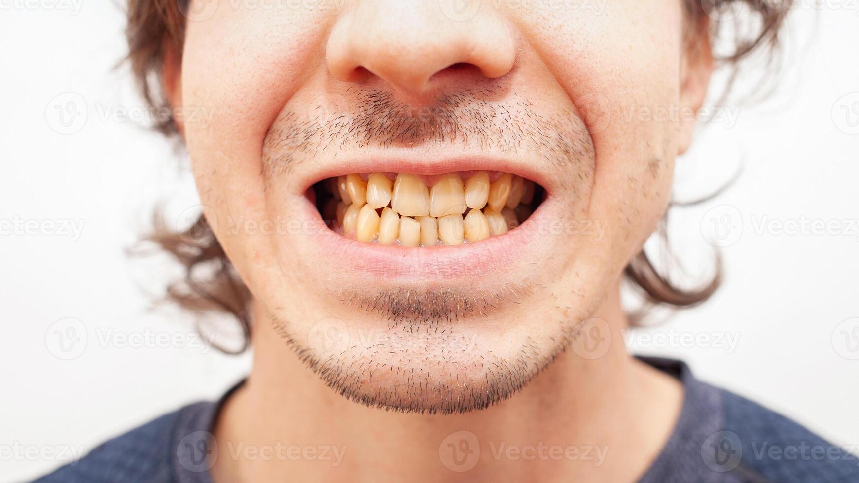 proche en haut portrait sourire les dents homme. Jaune laid les dents de fumeur, alcool, maladie. courbé sale photo