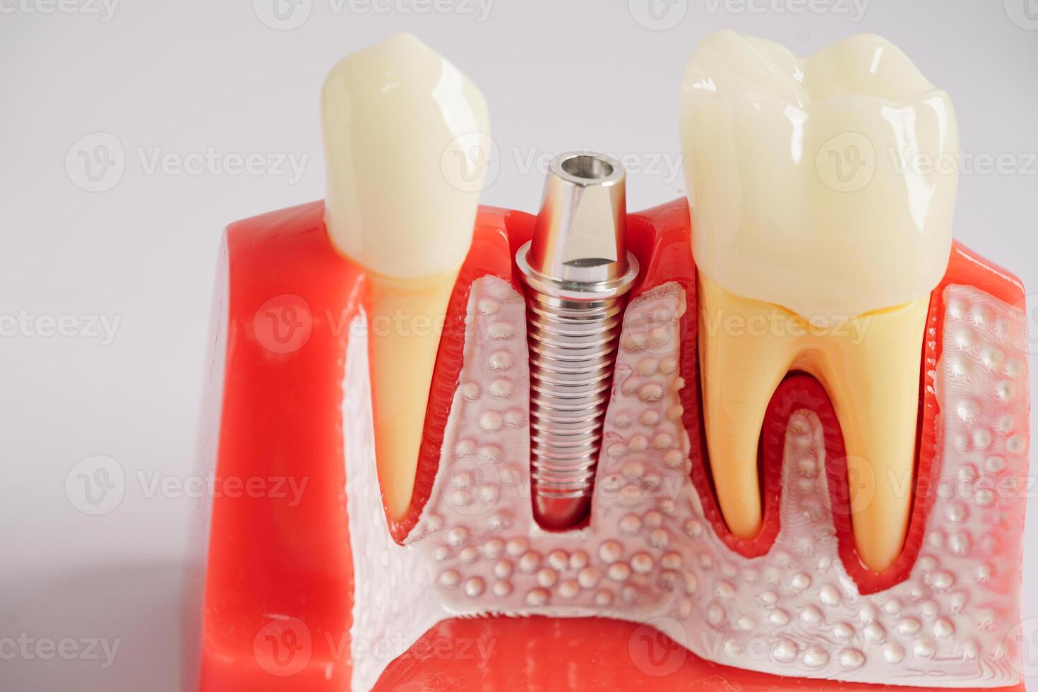 dentaire implant, artificiel dent les racines dans mâchoire, racine canal de dentaire traitement, gencive maladie, les dents modèle pour dentiste en train d'étudier à propos dentisterie. photo