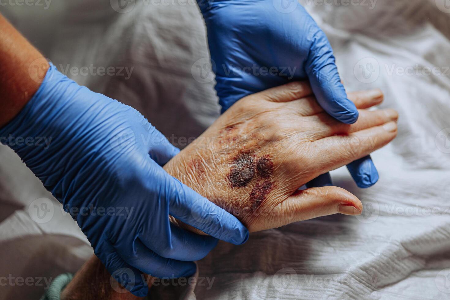 une bleu sur le main de un personnes âgées personne. connu comme sénile purpura. causé par le fragilité de le peau et du sang navires dans vieux âge. personnes âgées se soucier photo