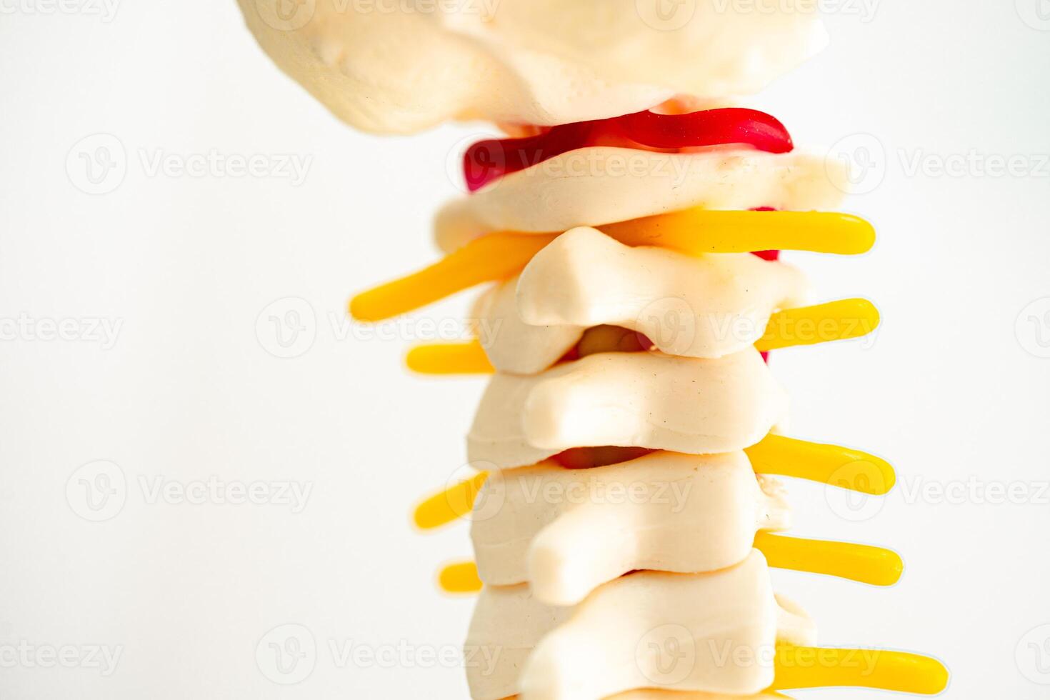 lombaire colonne vertébrale déplacé hernie disque fragment, spinal nerf et os. modèle sur blanc Contexte avec coupure chemin, pour traitement médical dans le orthopédique département. photo