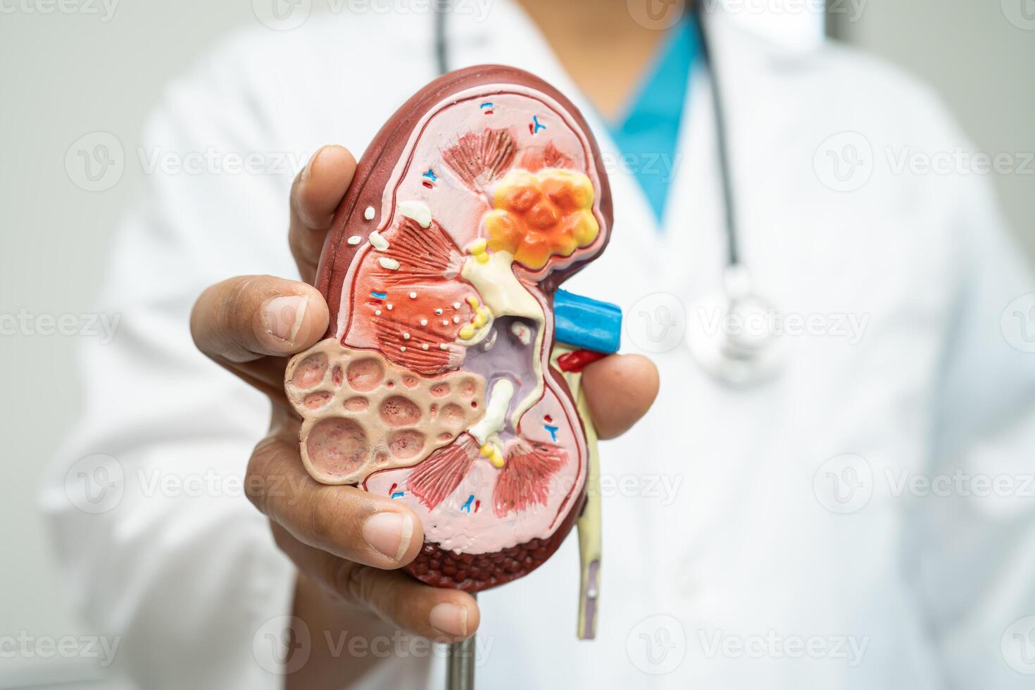 un rein maladie, chronique un rein maladie ccd, médecin avec Humain modèle à étude et traiter dans hôpital. photo