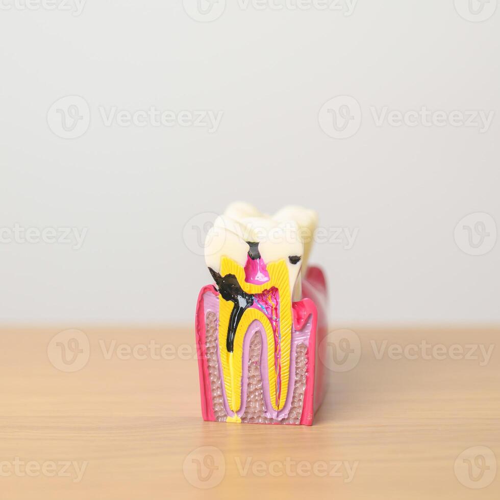 dent anatomie modèle. oral les dents pourriture et maladie, rayer de tartre. Mars oral santé, dentiste jour, faux dents. mal aux dents et les enfants dentaire santé mois et orthodontique santé journée photo