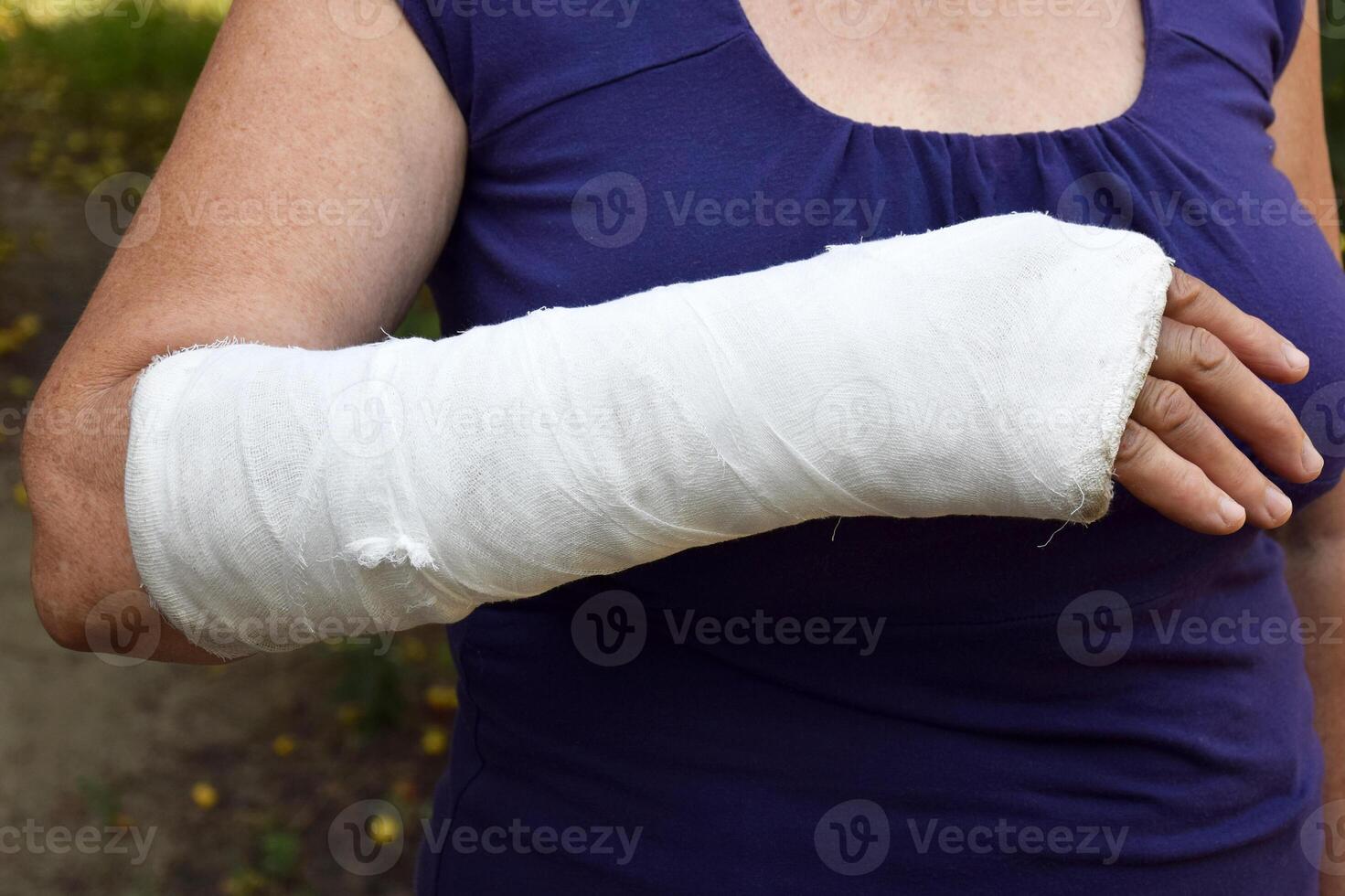 femme avec une cassé bras en plein air. le bras est couvert avec plâtre. photo