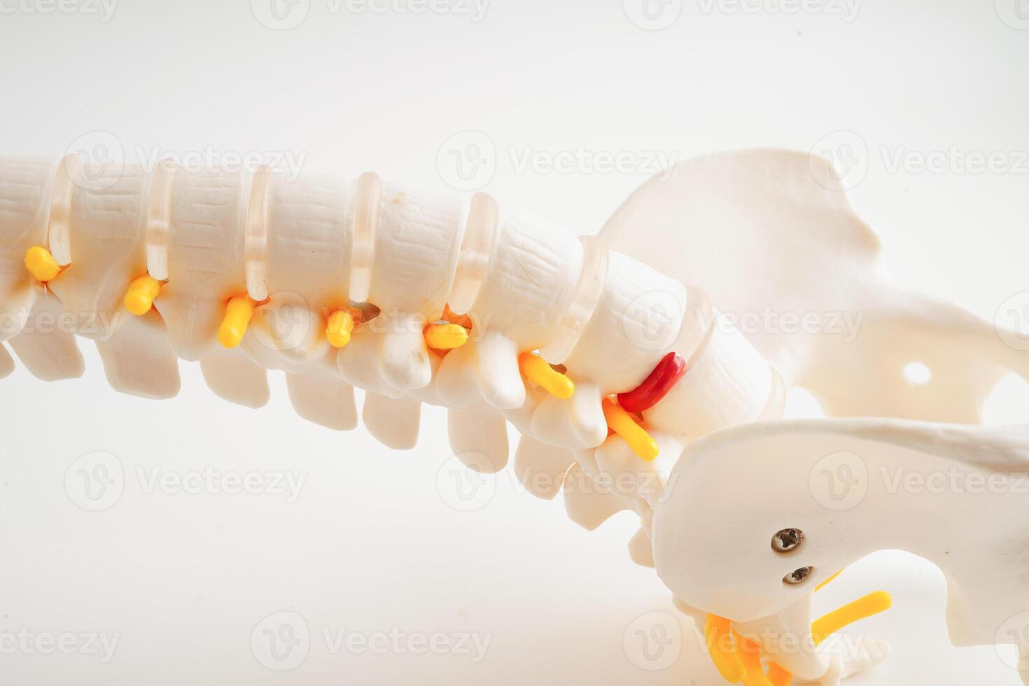 spinal nerf et os, lombaire colonne vertébrale déplacé hernie disque fragment, modèle pour traitement médical dans le orthopédique département. photo