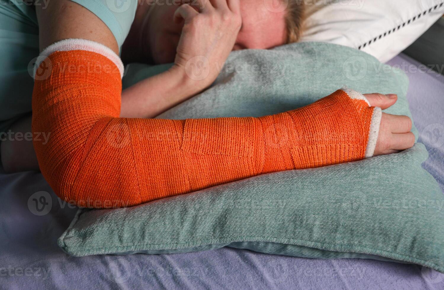 femme avec une cassé droite bras avec un Orange fibre de verre plâtre jeter dort dans lit avec une oreiller en dessous de le jeter photo