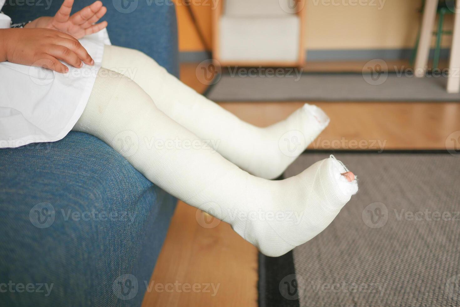 peu enfant avec plâtre bandage sur jambe. photo
