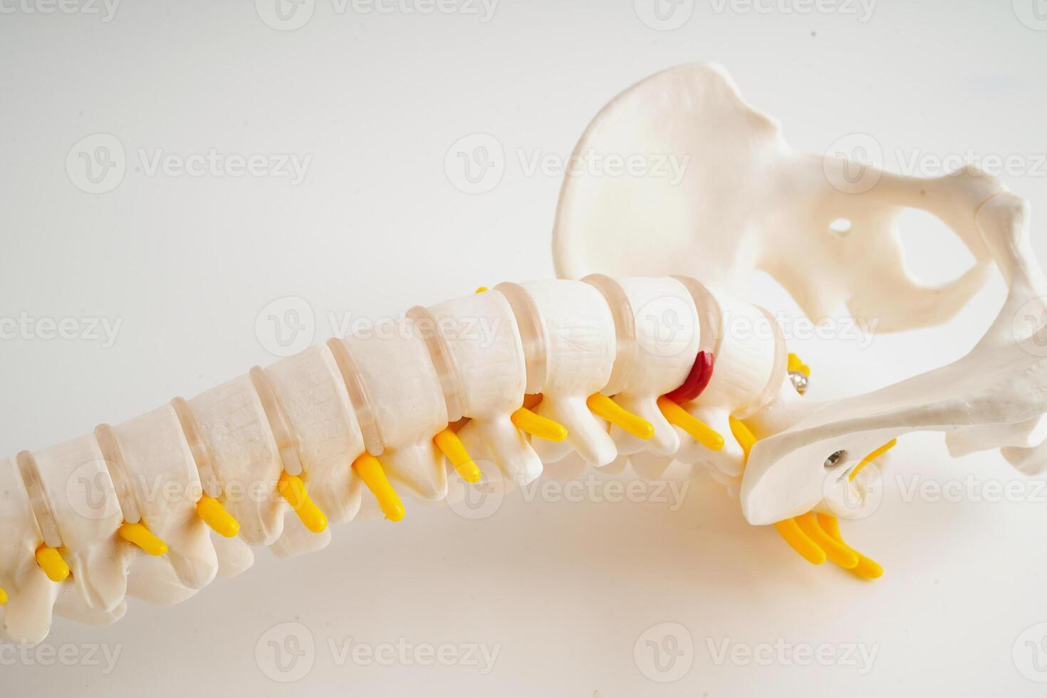 spinal nerf et os, lombaire colonne vertébrale déplacé hernie disque fragment, modèle pour traitement médical dans le orthopédique département. photo