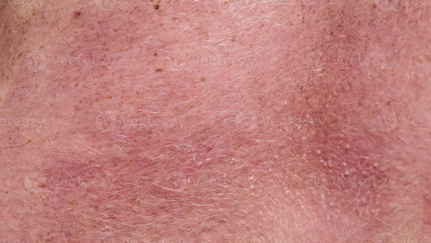 Humain peau texture, cheveux et les imperfections, Soleil allergie avec l'eau bulles photo