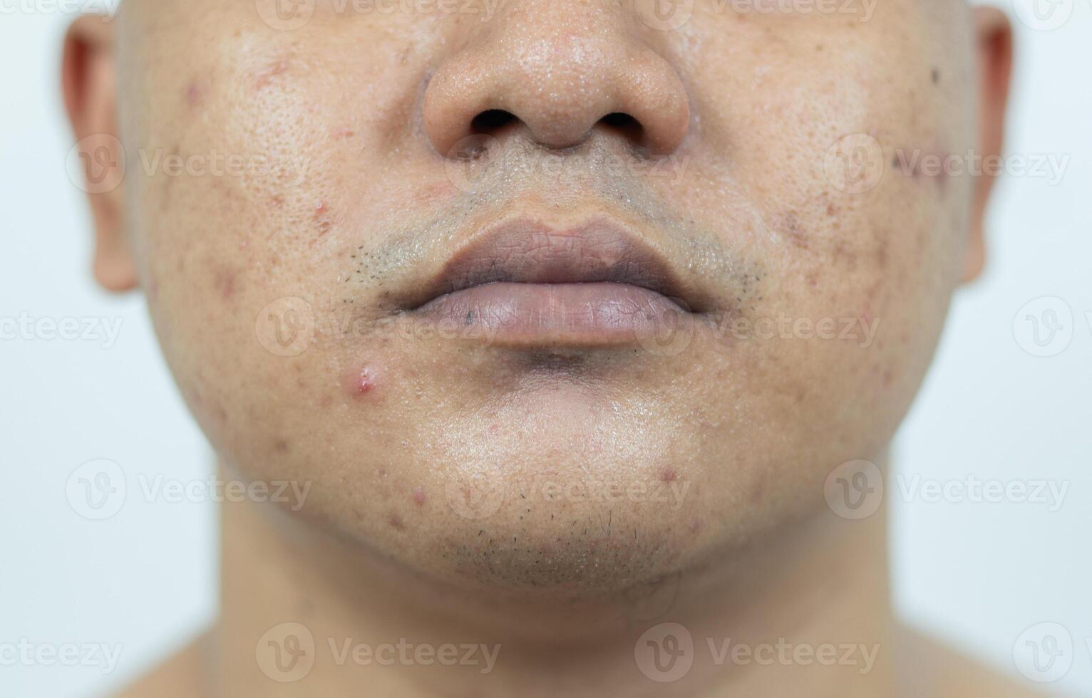 peau problèmes. problème de enflammé acné sur le affronter. enflammé acné consiste de gonflement, rougeur, et les pores cette sont gravement bouché avec bactéries, huile, et mort peau cellules. photo