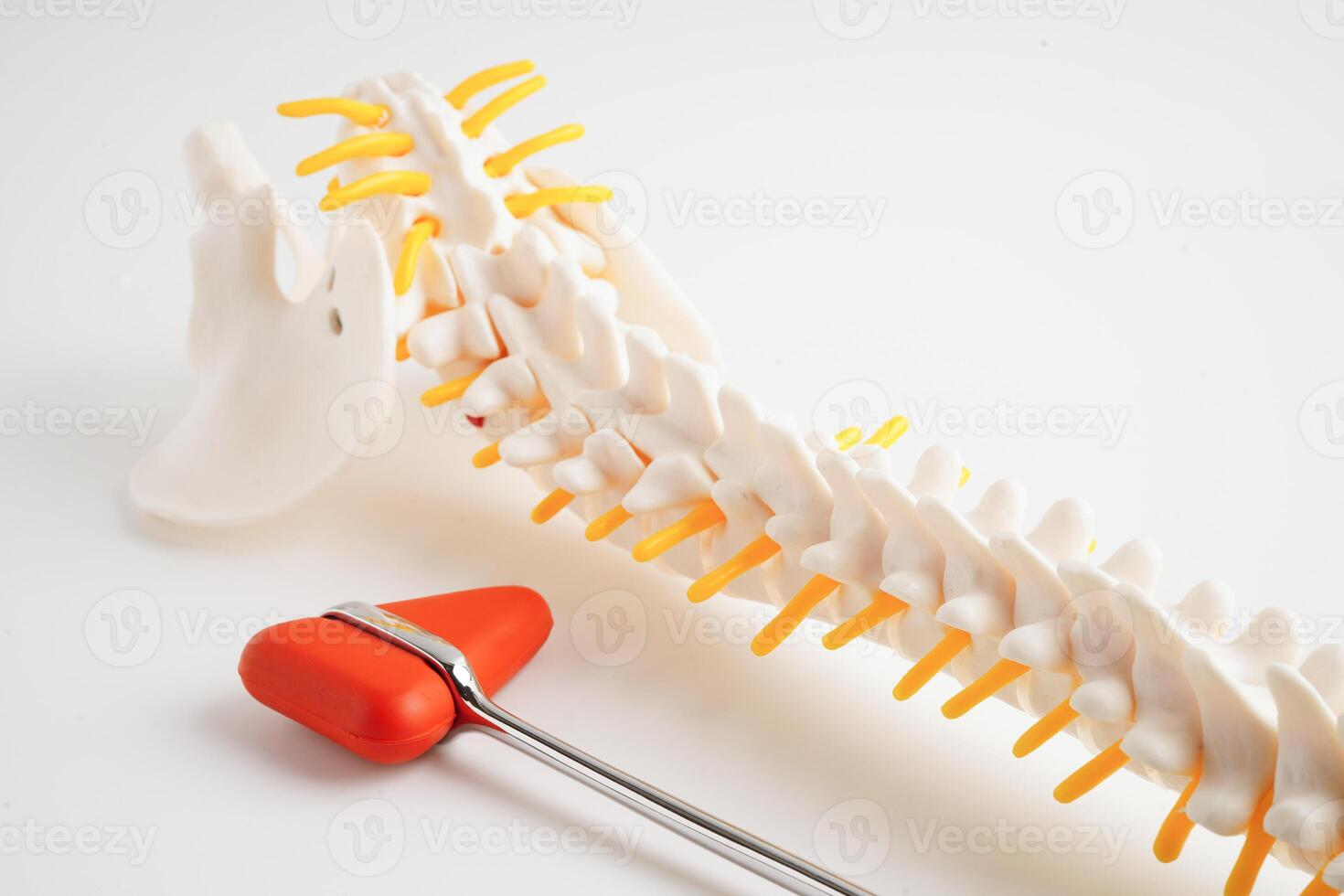 spinal nerf et OS avec le genou réflexe marteau, lombaire colonne vertébrale déplacé hernie disque fragment, modèle pour traitement médical dans le orthopédique département. photo