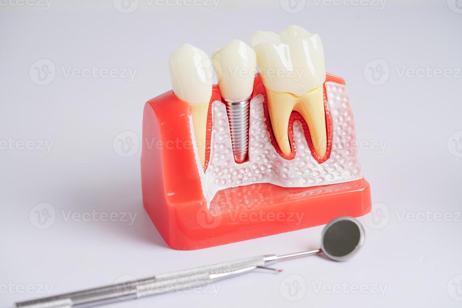 dentaire implant, artificiel dent les racines dans mâchoire, racine canal de dentaire traitement, gencive maladie, les dents modèle pour dentiste en train d'étudier à propos dentisterie. photo