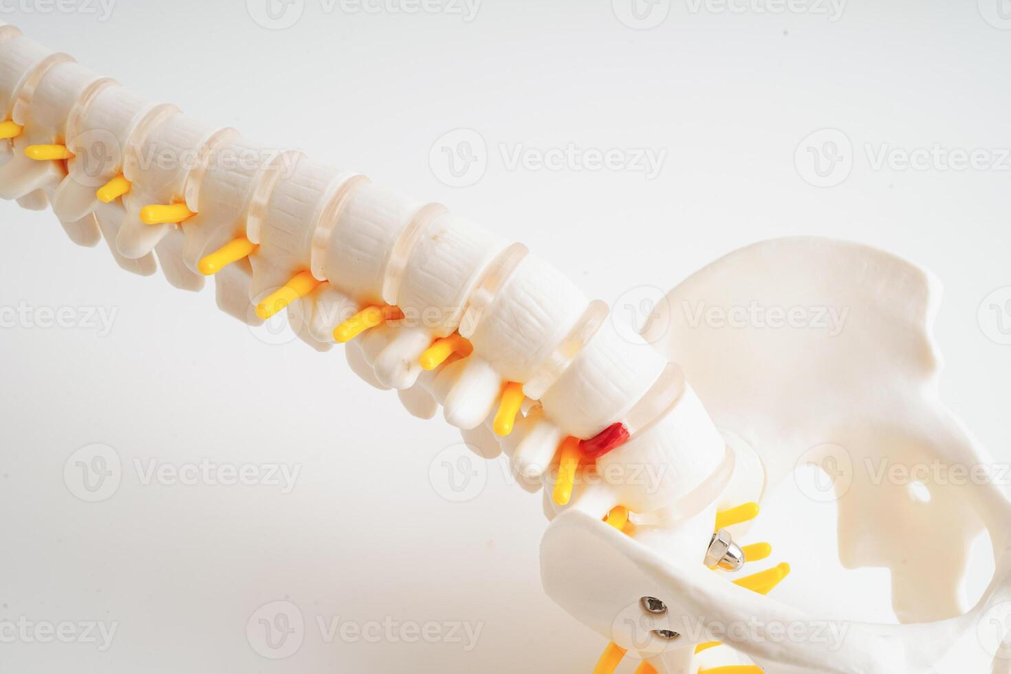 spinal nerf et os, lombaire colonne vertébrale déplacé hernie disque fragment, modèle pour traitement médical dans le orthopédique département. photo