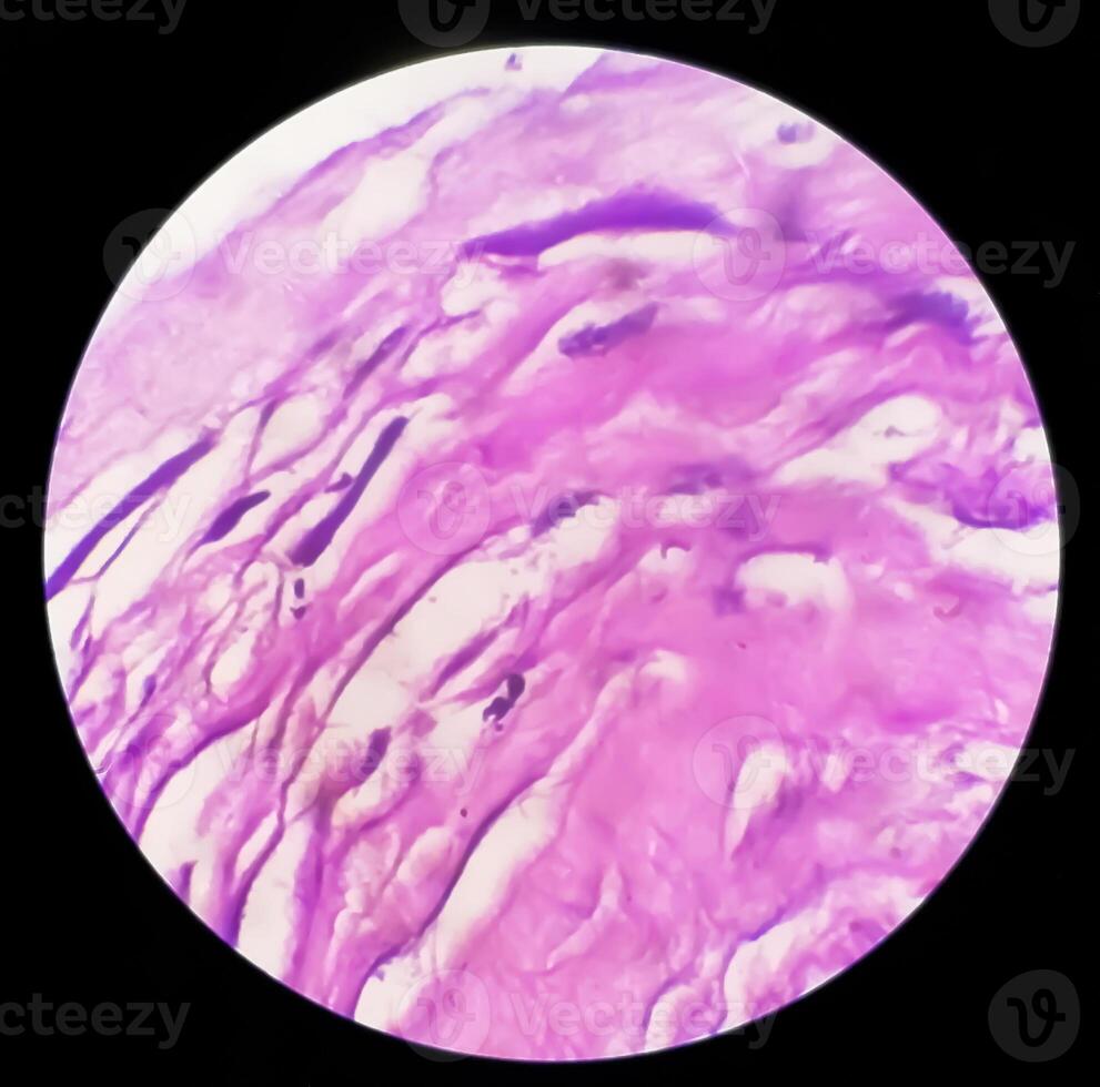 photomicrographie de histologique faire glisser montrant lobulaire capillaire hémangiome sur doigt. photo