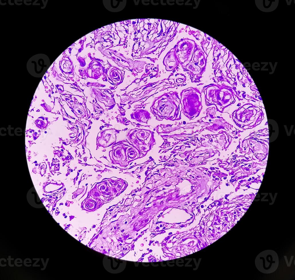 histologie, péritonéal inclusion kyste. paraovarien des kystes, hydrosalpinx et bas de gamme cystique mésothéliome sont d'habitude pris en considération dans le différentiel diagnostic de photos. photo