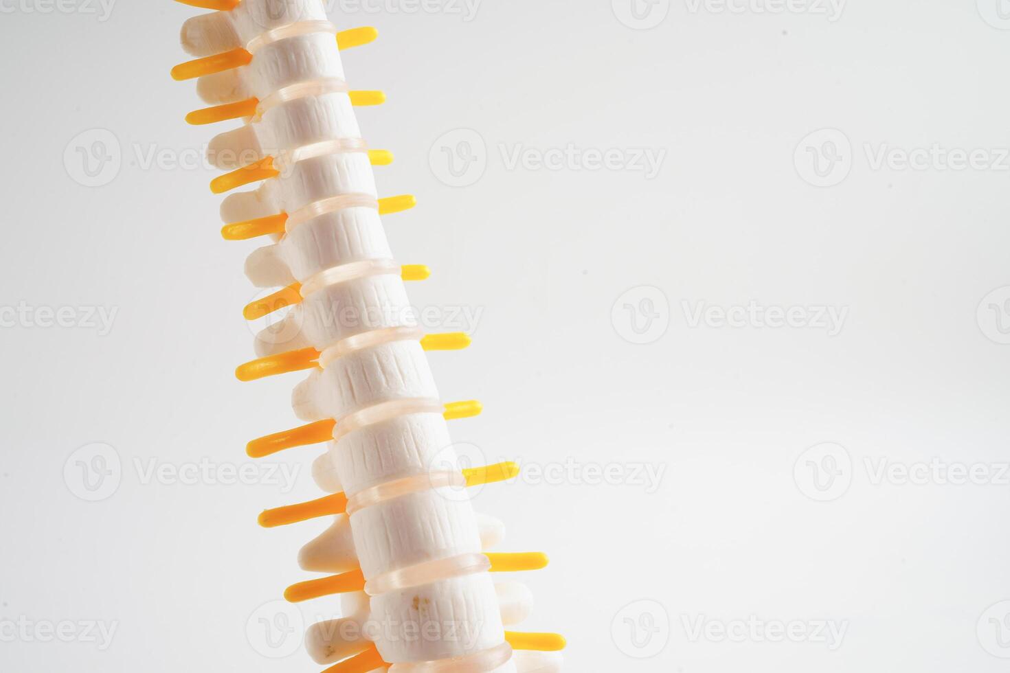 spinal nerf et os, lombaire colonne vertébrale déplacé hernie disque fragment, modèle pour traitement médical dans le orthopédique département. photo