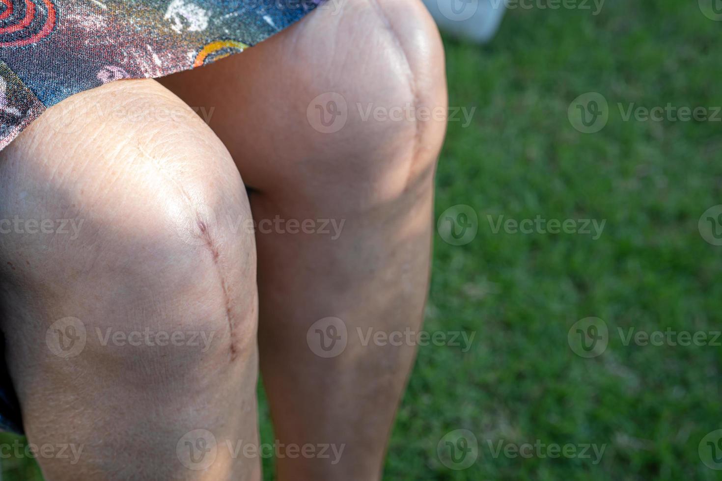 Dame âgée asiatique vieille femme patiente montre ses cicatrices arthroplastie totale du genou chirurgicale. photo