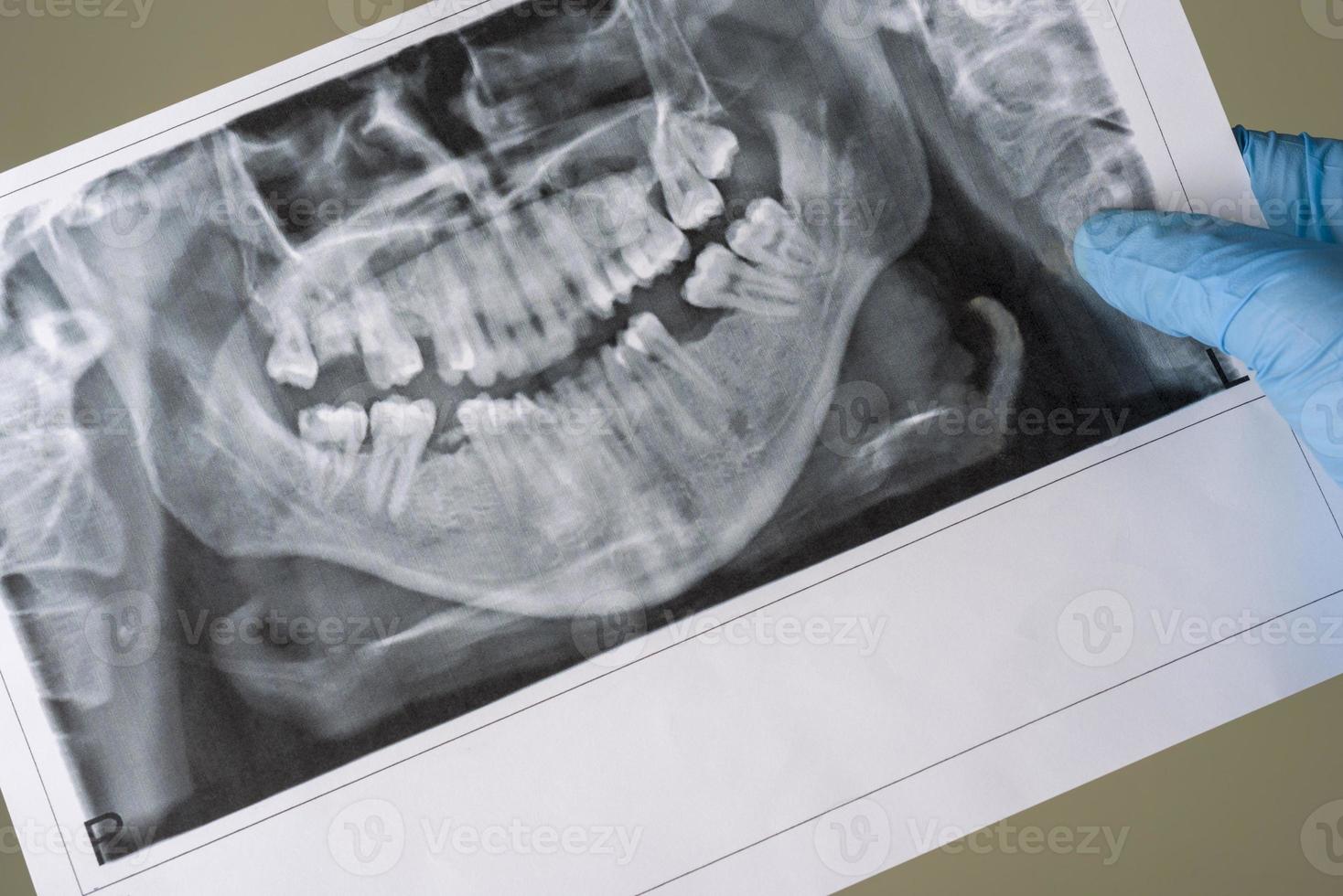 radiographie dentaire. une radiographie panoramique d'une bouche, avec zone douloureuse rouge. photo