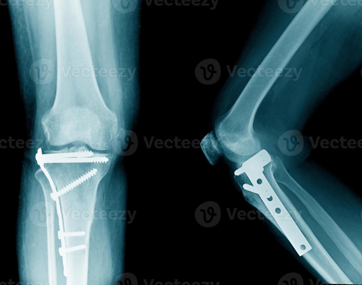 fracture du tibia avec fixation interne post-opératoire photo