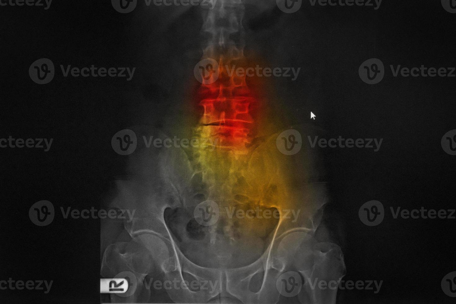 radiographie informatisée cr de la colonne vertébrale lombo-sarcale vue ap antéropostérieure montrant la spondylose et la scoliose de la colonne vertébrale photo