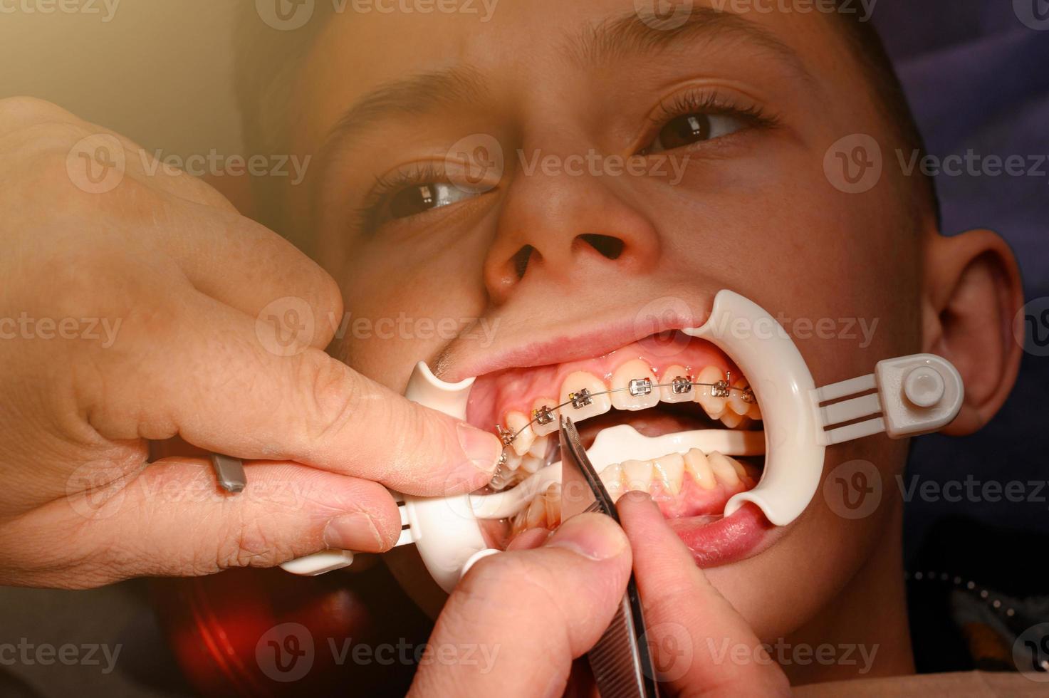 l'adolescent a un appareil dentaire collé à ses dents supérieures