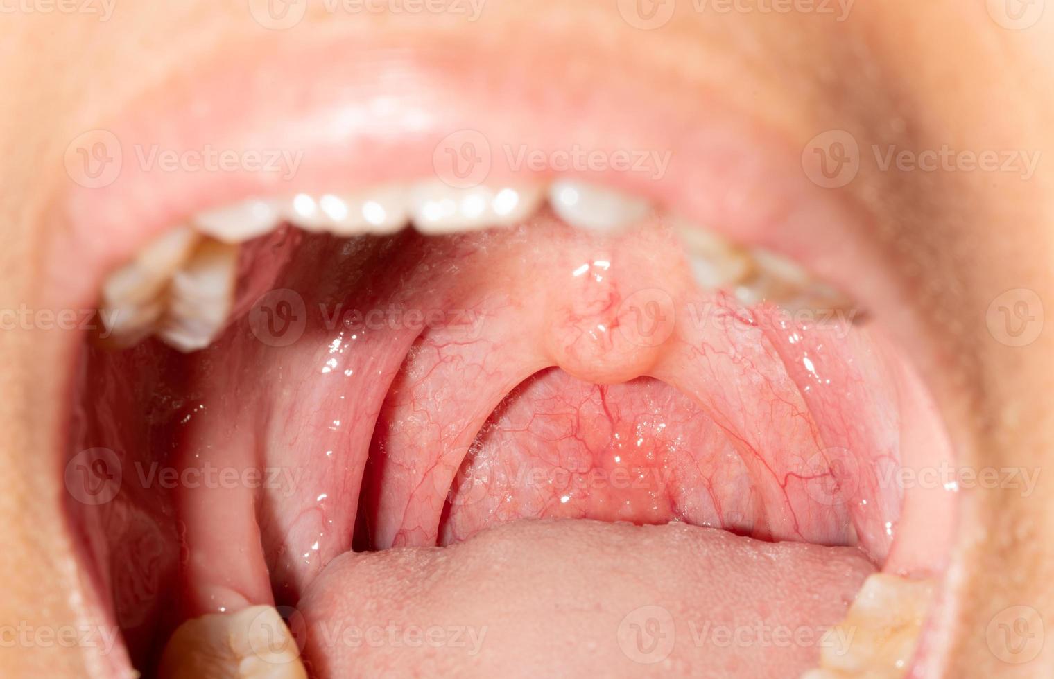 mal de gorge avec gorge gonflée. bouche ouverte en gros plan avec gonflement de la paroi pharyngienne postérieure et luette et amygdale. follicules grippaux dans la paroi postérieure du pharynx. des voies respiratoires supérieures. photo
