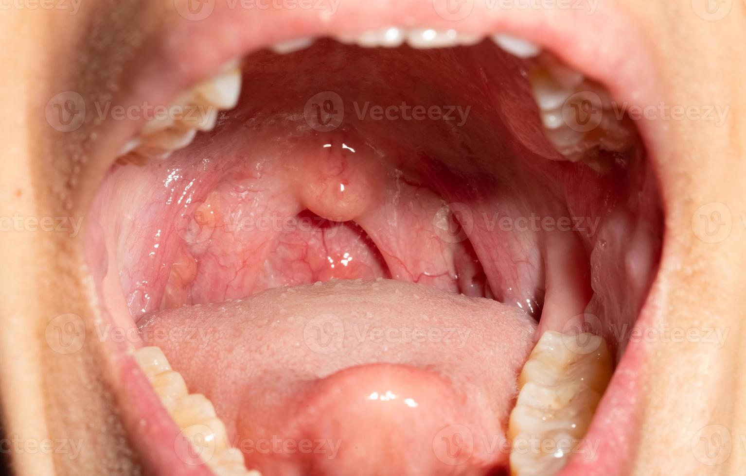 mal de gorge avec gorge gonflée. bouche ouverte en gros plan avec gonflement de la paroi pharyngienne postérieure et luette et amygdale. follicules grippaux dans la paroi postérieure du pharynx. des voies respiratoires supérieures. photo