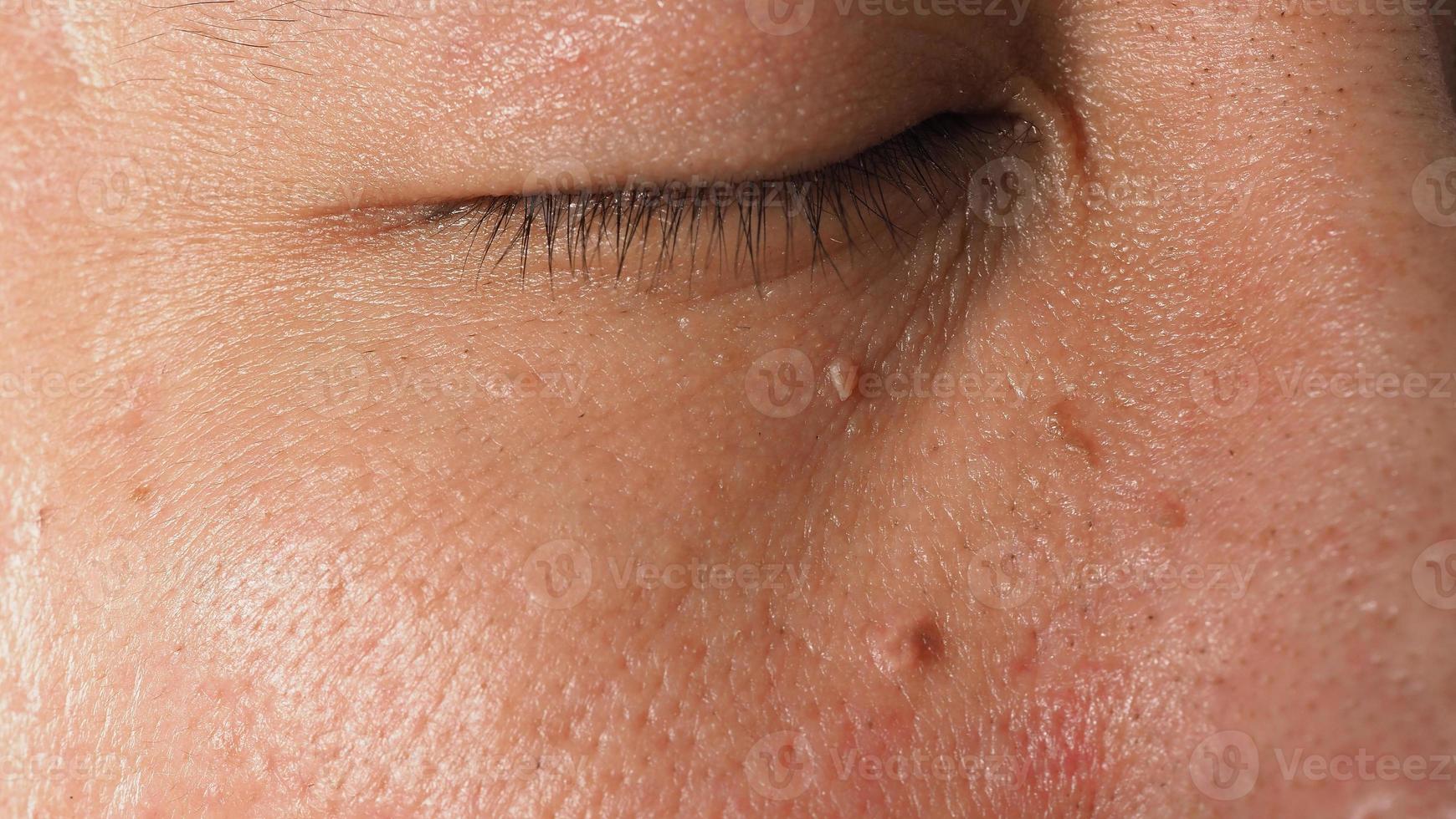 élimination de la peau des verrues. coup de macro de verrues près des yeux sur le visage. photo